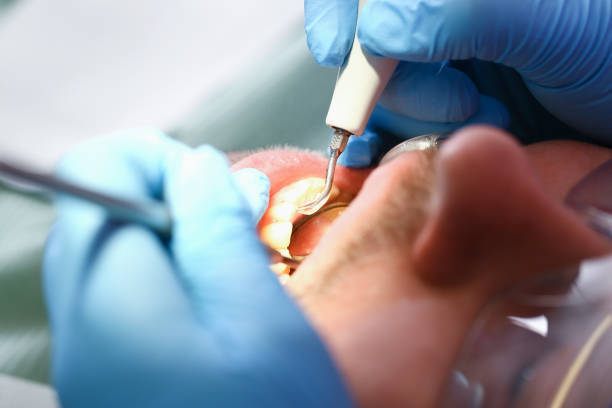 Best Dental Abscess Treatment in Richgrove, CA