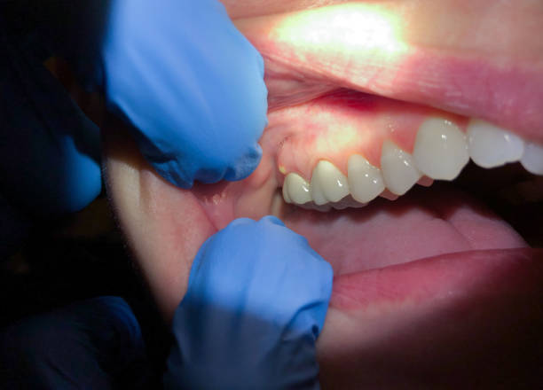 Best Emergency Denture Repair in Richgrove, CA
